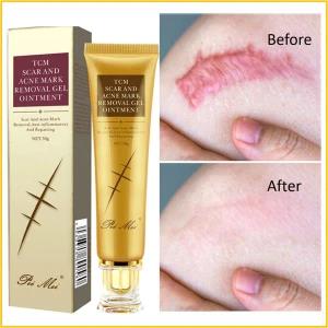 Generic 30g Gel Acne Scar Pimple Stretch Mark Removal